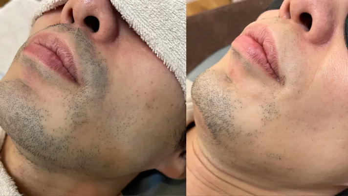 ヒゲ脱毛効果写真◎30代 6回後|東広島でメンズ脱毛ならb.B.男性専用脱毛サロンへ