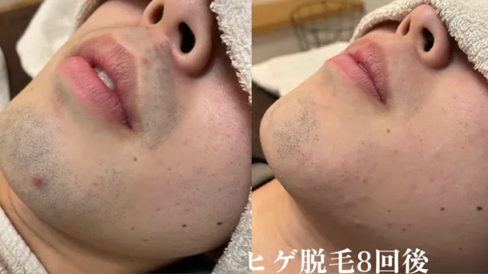 ★ヒゲ脱毛効果写真★(男性/10代/学生)ヒゲ脱毛8回後|東広島でメンズ脱毛ならb.B.男性専用脱毛サロンへ