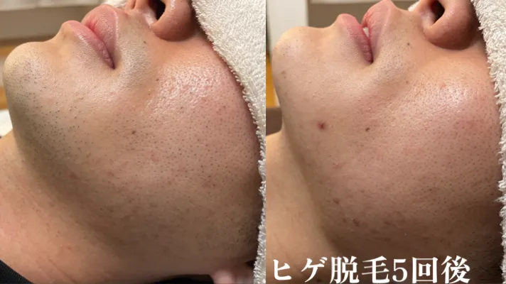 ★ヒゲ脱毛効果写真★ヒゲ脱毛5回後(男性/20代/学生)|東広島でメンズ脱毛ならb.B.男性専用脱毛サロンへ